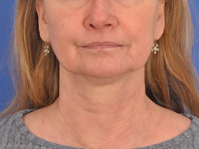 CO2RE Laser Before & After Gallery - Patient 106102 - Image 2