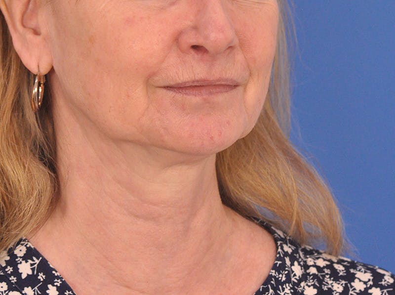 CO2RE Laser Before & After Gallery - Patient 106102 - Image 3