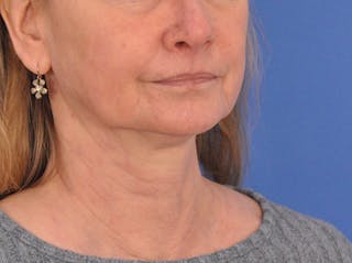 CO2RE Laser Before & After Gallery - Patient 106102 - Image 4