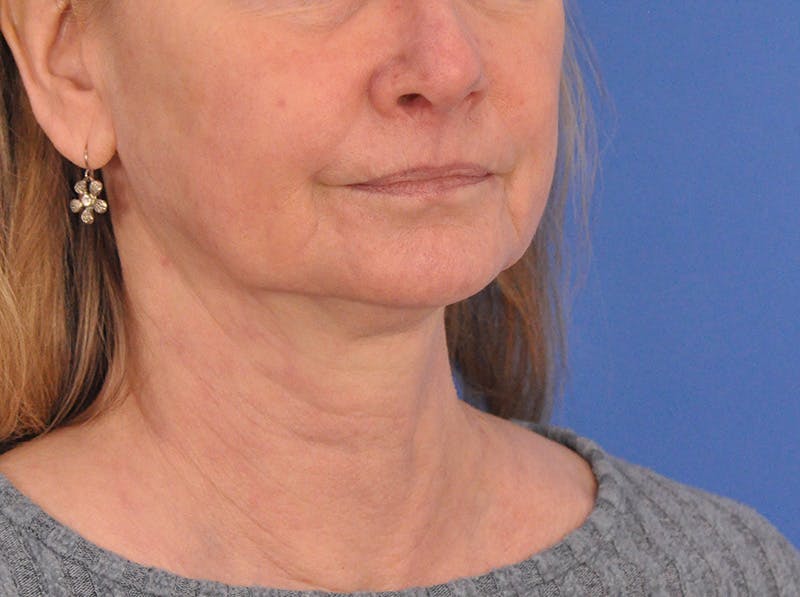 CO2RE Laser Before & After Gallery - Patient 106102 - Image 4