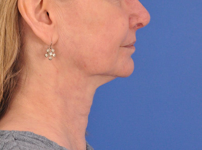 CO2RE Laser Before & After Gallery - Patient 106102 - Image 6