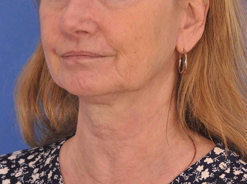 CO2RE Laser Before & After Gallery - Patient 106102 - Image 7
