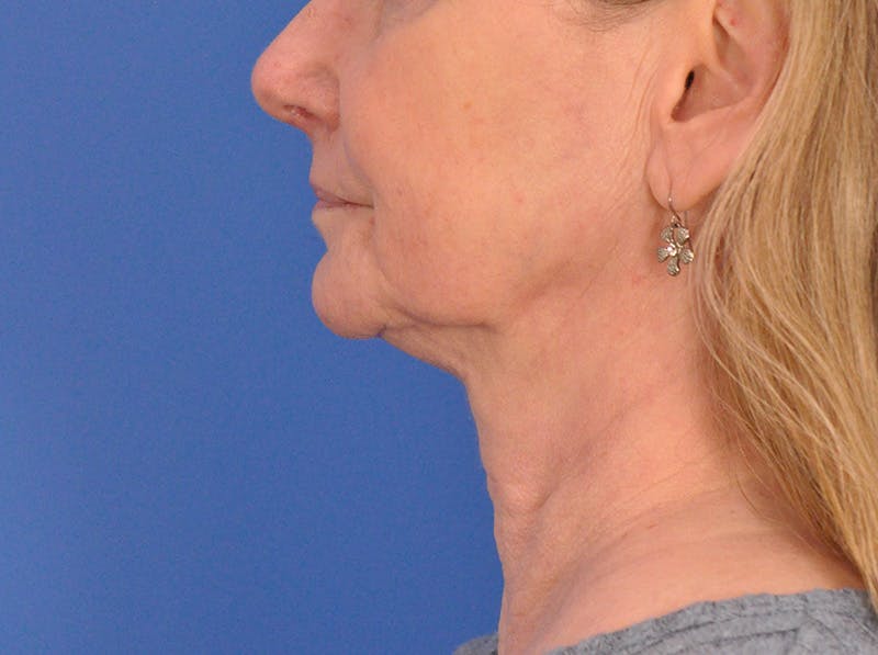CO2RE Laser Before & After Gallery - Patient 106102 - Image 10