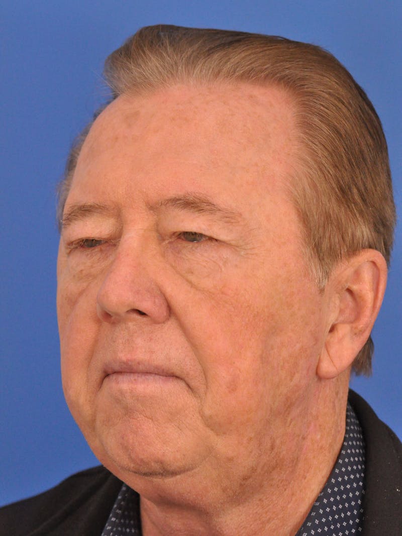 Brow Lift Before & After Gallery - Patient 152545 - Image 3
