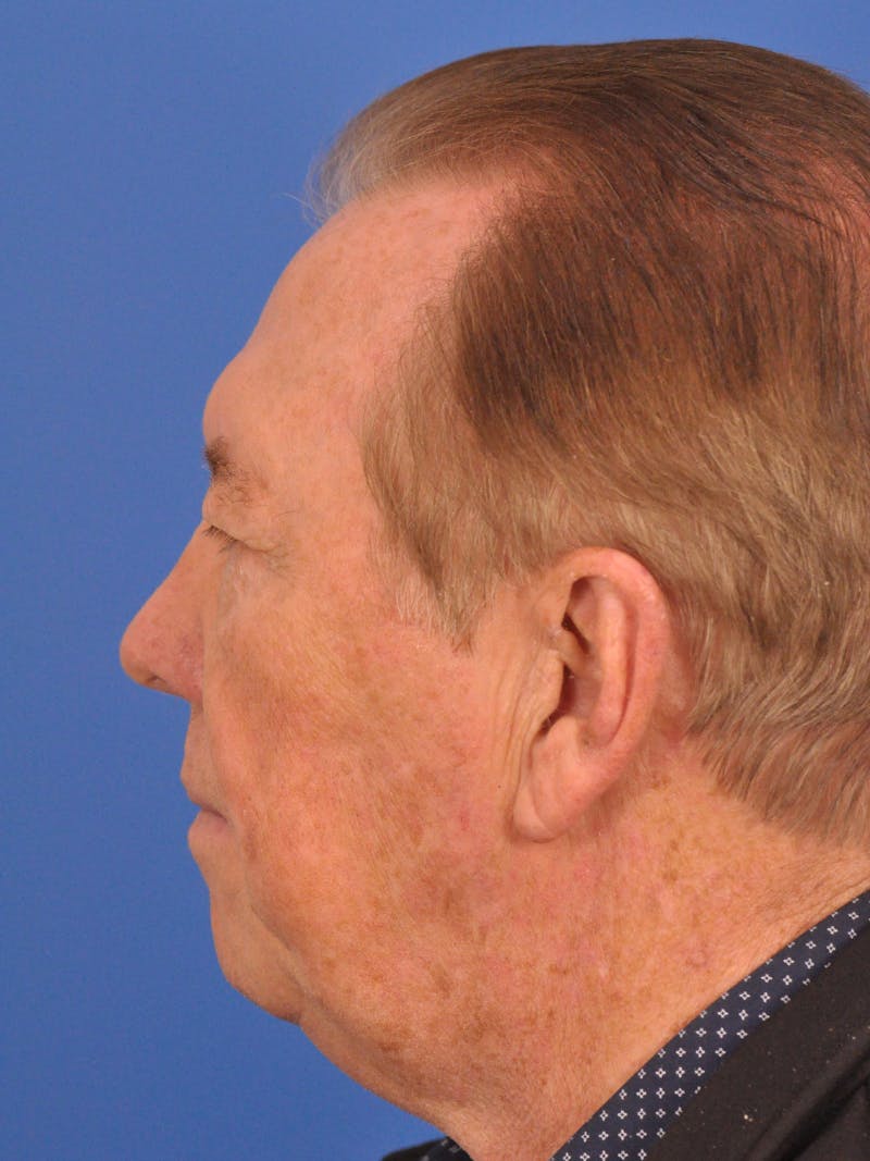 Brow Lift Before & After Gallery - Patient 152545 - Image 7