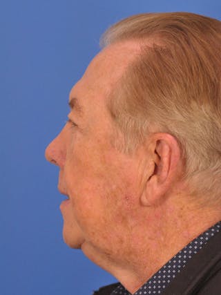 Brow Lift Before & After Gallery - Patient 152545 - Image 8