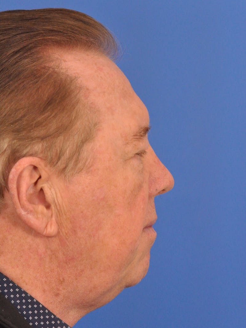 Brow Lift Before & After Gallery - Patient 152545 - Image 9