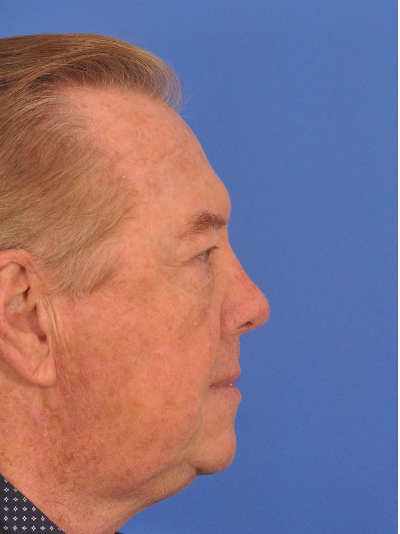 Brow Lift Before & After Gallery - Patient 152545 - Image 10