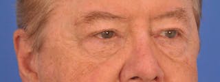 Blepharoplasty Before & After Gallery - Patient 192201 - Image 6