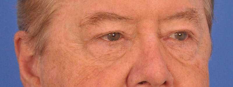 Blepharoplasty Before & After Gallery - Patient 192201 - Image 6