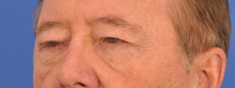 Blepharoplasty Before & After Gallery - Patient 192201 - Image 3
