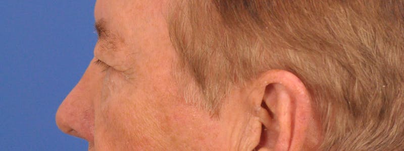 Blepharoplasty Before & After Gallery - Patient 192201 - Image 7