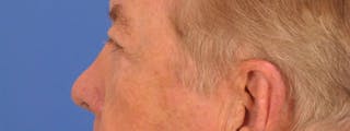 Blepharoplasty Before & After Gallery - Patient 192201 - Image 8