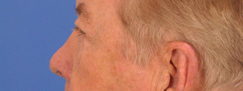 Blepharoplasty Before & After Gallery - Patient 192201 - Image 8