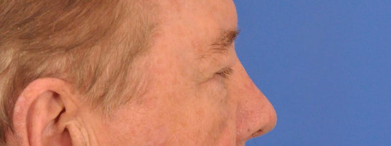 Blepharoplasty Before & After Gallery - Patient 192201 - Image 9