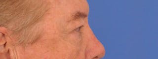 Blepharoplasty Before & After Gallery - Patient 192201 - Image 10