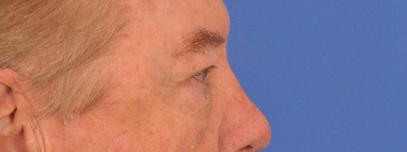 Blepharoplasty Before & After Gallery - Patient 192201 - Image 10