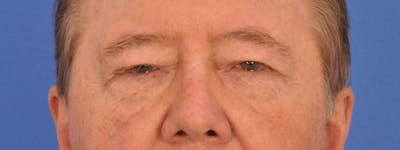 Blepharoplasty Before & After Gallery - Patient 192201 - Image 1