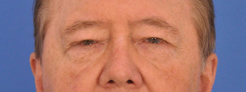 Blepharoplasty Before & After Gallery - Patient 192201 - Image 1