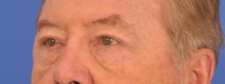 Blepharoplasty Before & After Gallery - Patient 192201 - Image 4