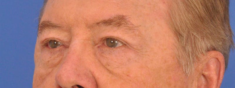 Blepharoplasty Before & After Gallery - Patient 192201 - Image 4