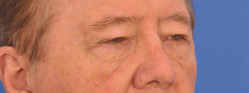 Blepharoplasty Before & After Gallery - Patient 192201 - Image 5