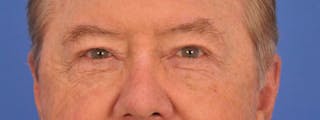Blepharoplasty Before & After Gallery - Patient 192201 - Image 2
