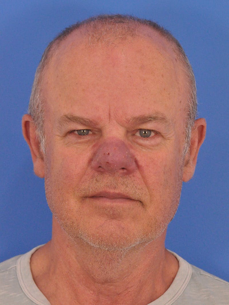 Vbeam Laser Before & After Gallery - Patient 170455 - Image 1