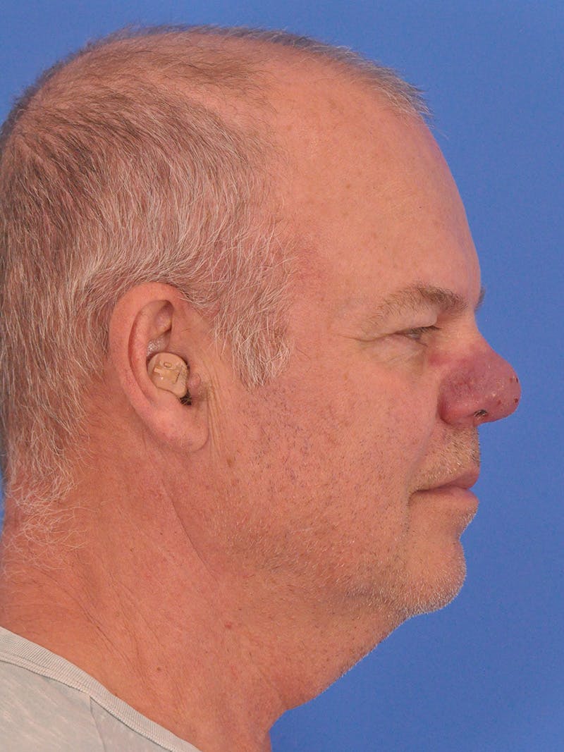 Vbeam Laser Before & After Gallery - Patient 170455 - Image 5