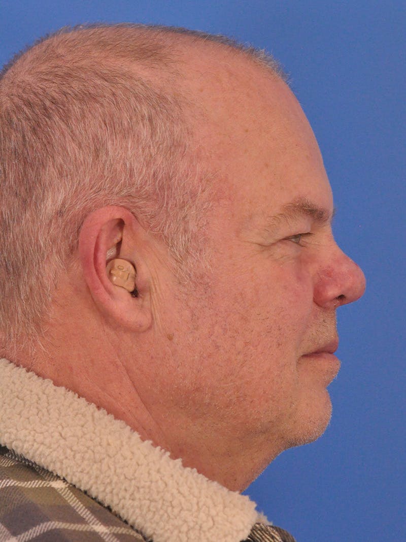 Vbeam Laser Before & After Gallery - Patient 170455 - Image 6
