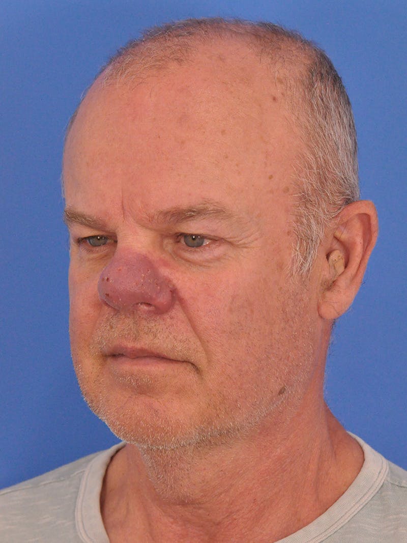 Vbeam Laser Before & After Gallery - Patient 170455 - Image 7