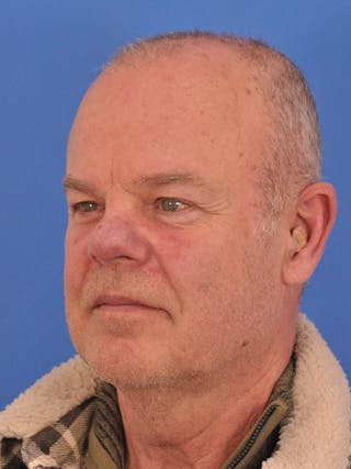 Vbeam Laser Before & After Gallery - Patient 170455 - Image 8