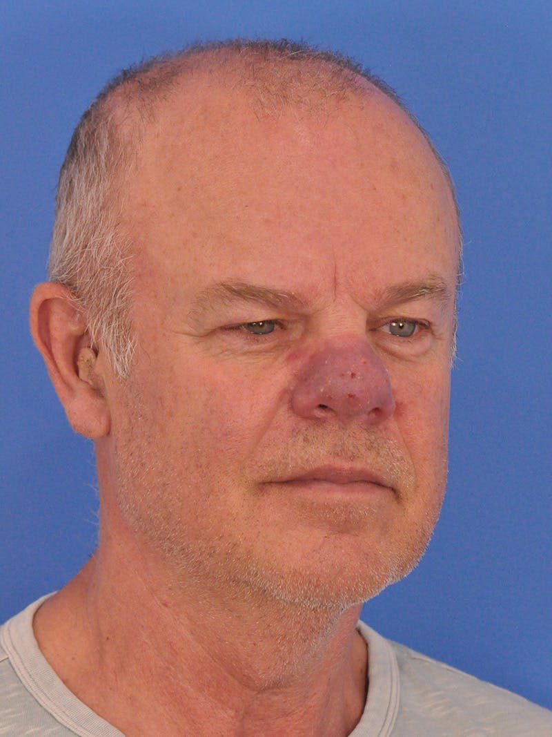 Vbeam Laser Before & After Gallery - Patient 170455 - Image 3