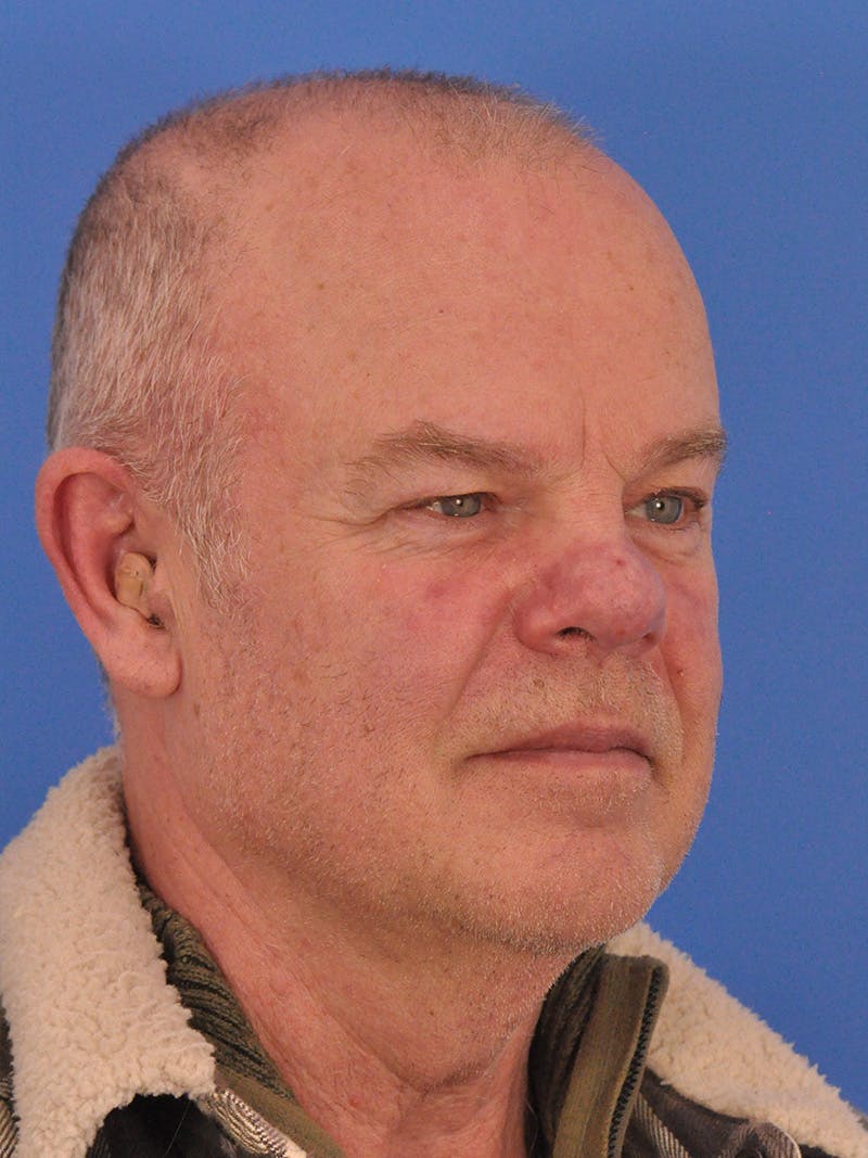 Vbeam Laser Before & After Gallery - Patient 170455 - Image 4