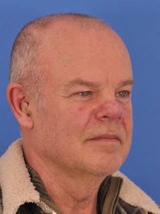 Vbeam Laser Before & After Gallery - Patient 170455 - Image 4