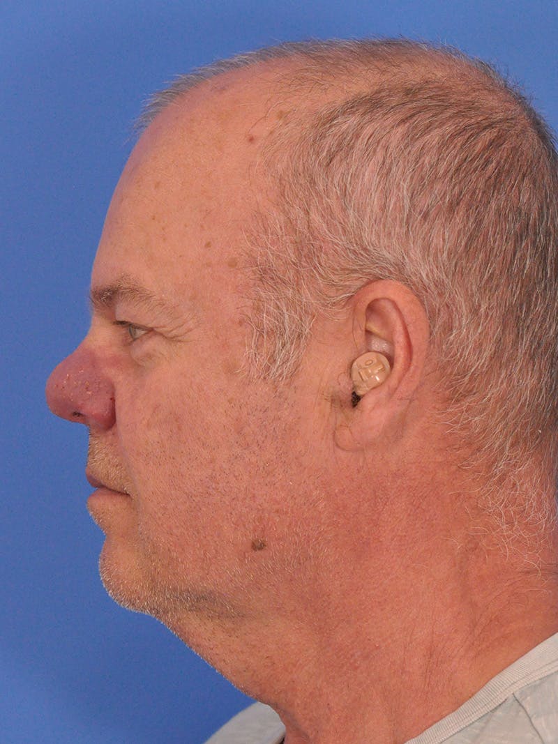 Vbeam Laser Before & After Gallery - Patient 170455 - Image 9