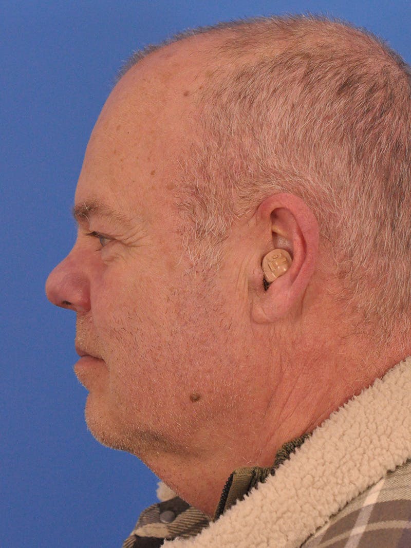 Vbeam Laser Before & After Gallery - Patient 170455 - Image 10