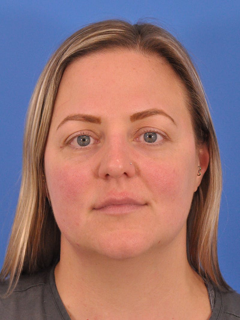 Brow Lift Before & After Gallery - Patient 131653 - Image 1