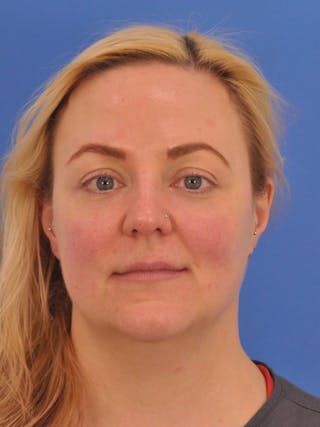 Brow Lift Before & After Gallery - Patient 131653 - Image 2