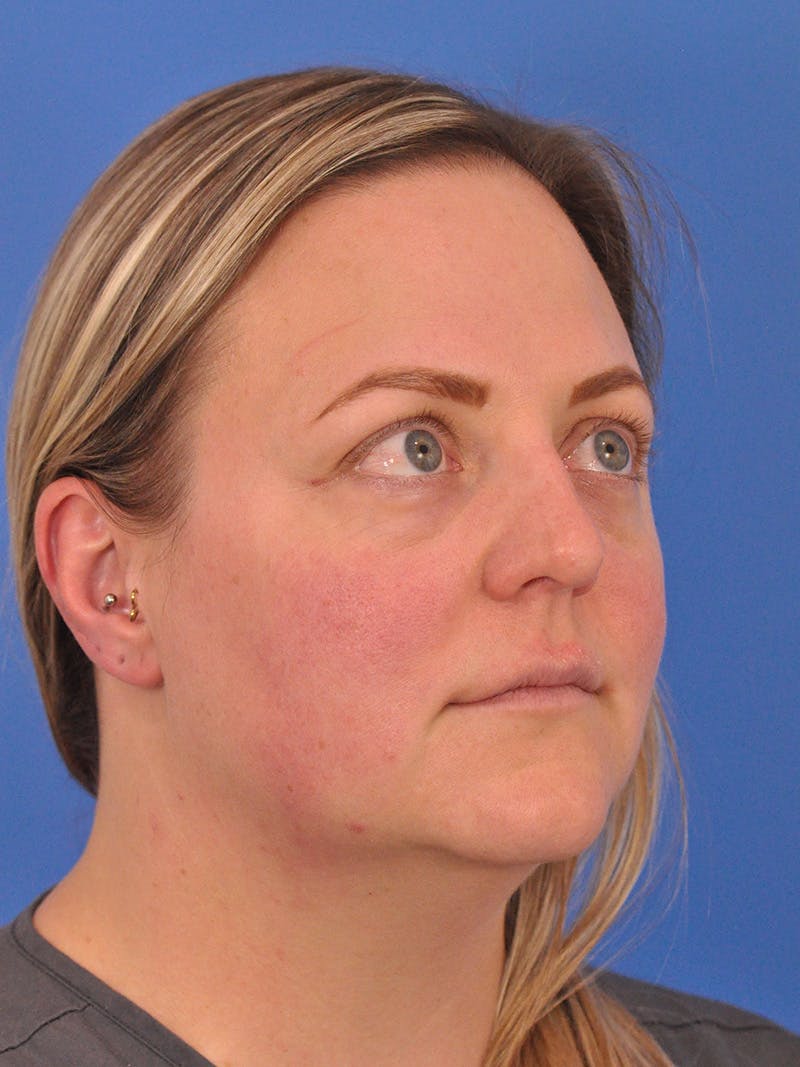 Brow Lift Before & After Gallery - Patient 131653 - Image 3