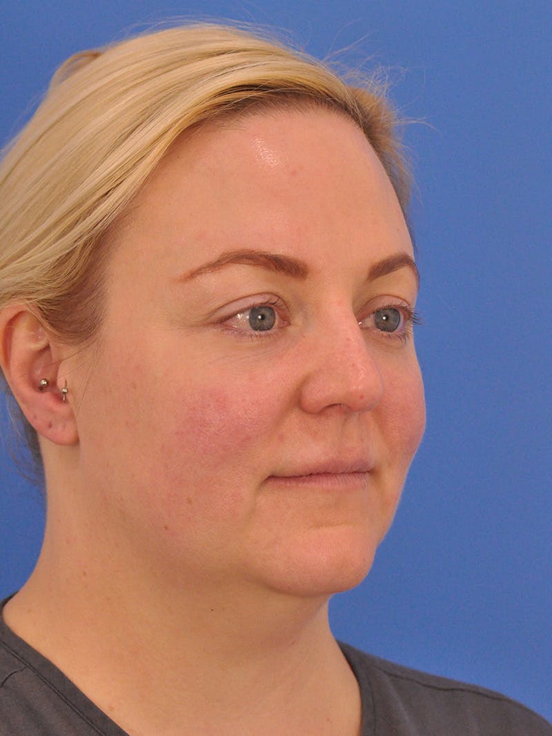 Brow Lift Before & After Gallery - Patient 131653 - Image 4