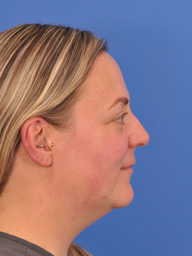 Brow Lift Before & After Gallery - Patient 131653 - Image 5