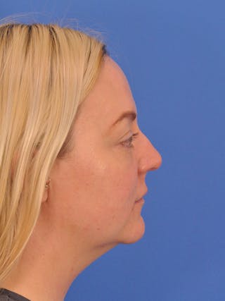 Brow Lift Before & After Gallery - Patient 131653 - Image 6