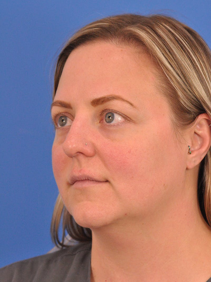 Brow Lift Before & After Gallery - Patient 131653 - Image 7