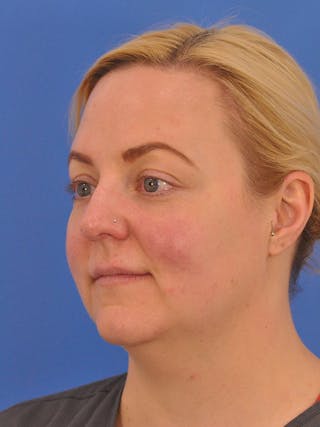 Brow Lift Before & After Gallery - Patient 131653 - Image 8