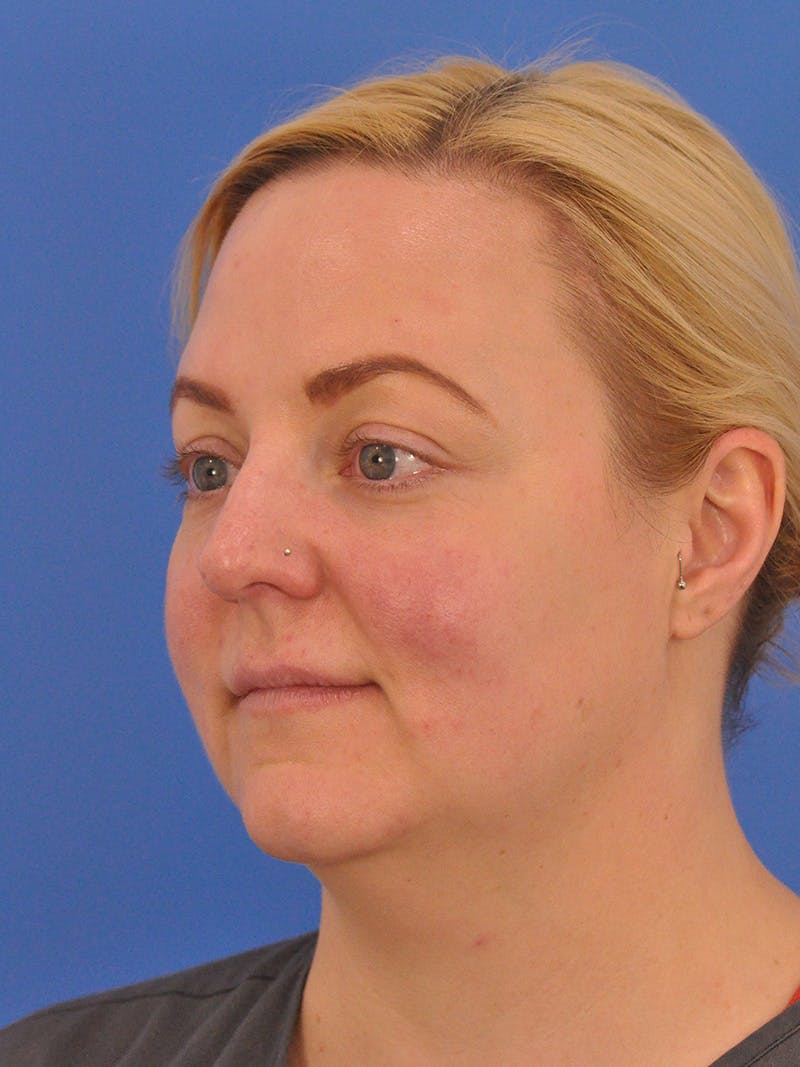 Brow Lift Before & After Gallery - Patient 131653 - Image 8