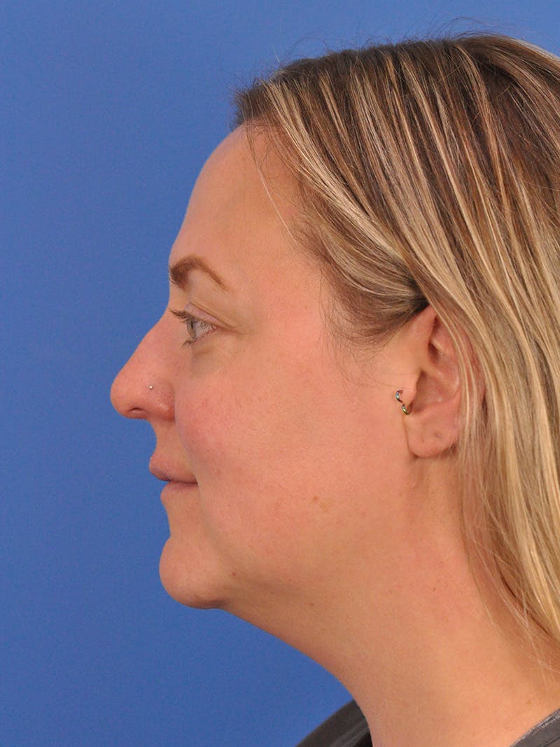 Brow Lift Before & After Gallery - Patient 131653 - Image 9