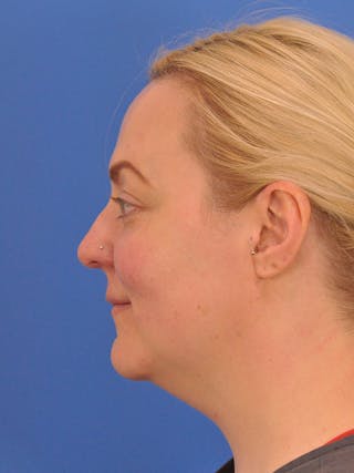 Brow Lift Before & After Gallery - Patient 131653 - Image 10