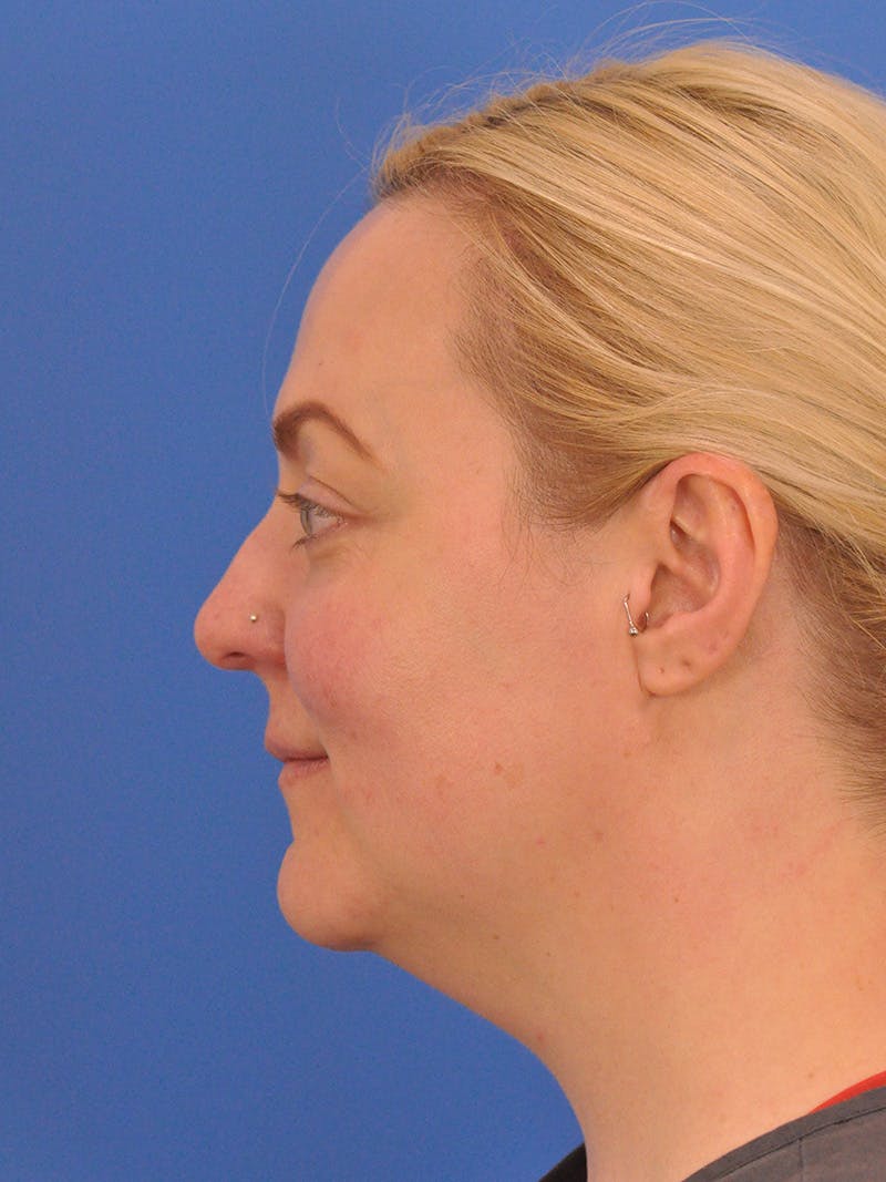 Brow Lift Before & After Gallery - Patient 131653 - Image 10