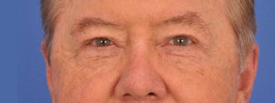 Blepharoplasty Before & After Gallery - Patient 192201 - Image 2